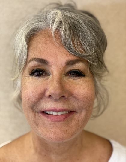 Woman with discolored dental bonding and imperfect smile