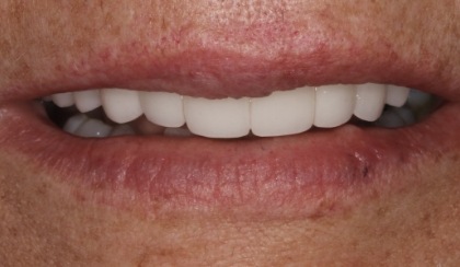 Closeup of woman's flawless smile after porcelain veneer treatment