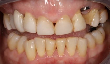 Closeup of woman's discolored dental bonding and imperfect smile