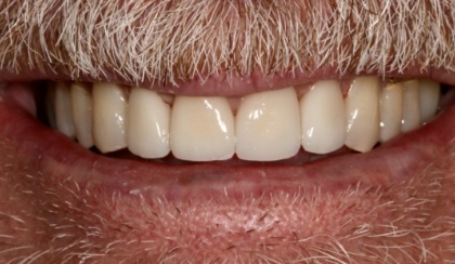 Closeup of woman's flawless smile after porcelain veneer treatment