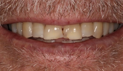 Closeup of woman's discolored dental bonding and imperfect smile