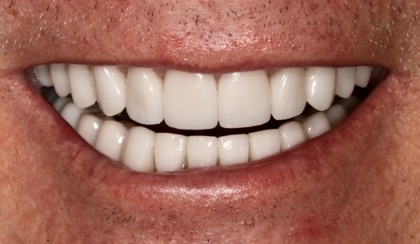 Closeup of woman's flawless smile after porcelain veneer treatment