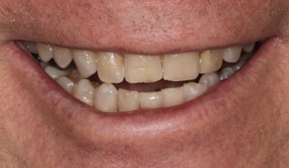 Closeup of woman's discolored dental bonding and imperfect smile