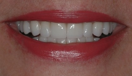 Closeup of woman's flawless smile after porcelain veneer treatment