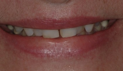 Closeup of woman's discolored dental bonding and imperfect smile