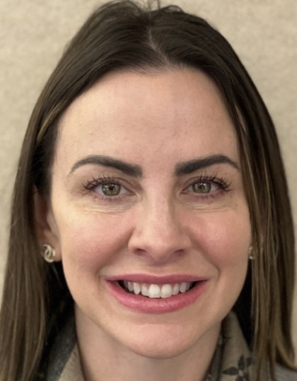 Woman with discolored dental bonding and imperfect smile