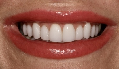 Closeup of woman's flawless smile after porcelain veneer treatment