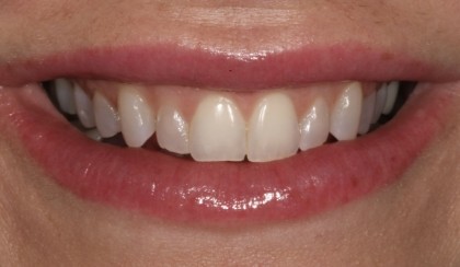 Closeup of woman's discolored dental bonding and imperfect smile