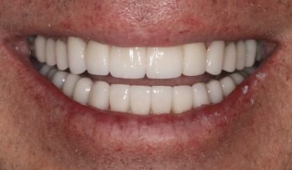 Closeup of woman's flawless smile after porcelain veneer treatment