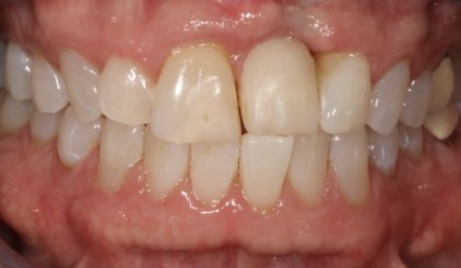 Closeup of woman's discolored dental bonding and imperfect smile