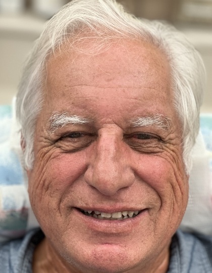 Woman with discolored dental bonding and imperfect smile