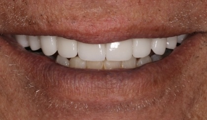 Closeup of woman's flawless smile after porcelain veneer treatment