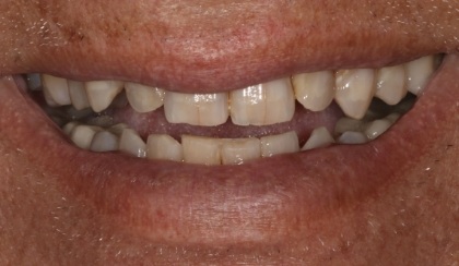 Closeup of woman's discolored dental bonding and imperfect smile