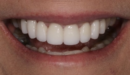 Closeup of woman's flawless smile after porcelain veneer treatment