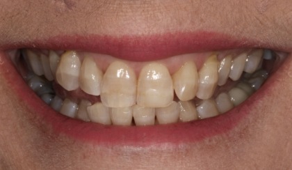 Closeup of woman's discolored dental bonding and imperfect smile