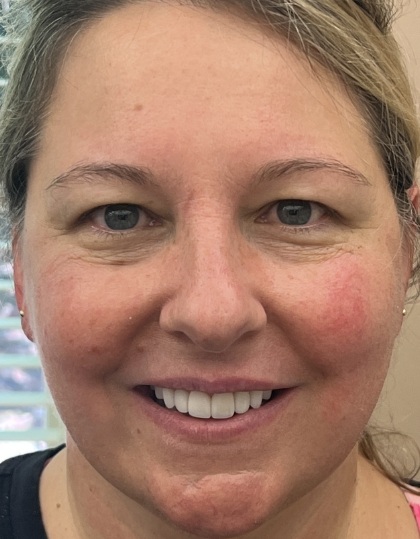 Woman with flawless smile after porecelain veneer treatment