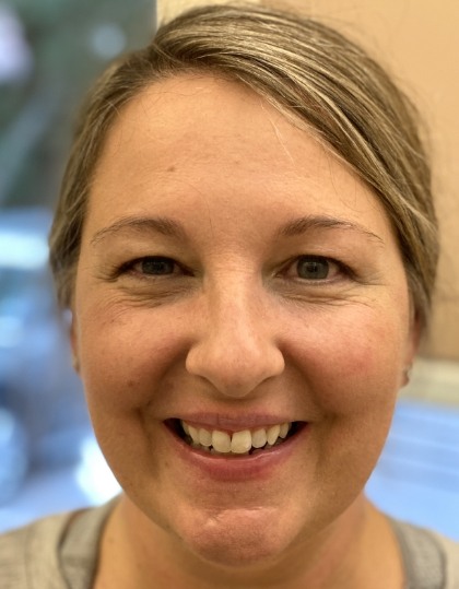 Woman with discolored dental bonding and imperfect smile