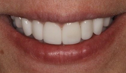 Closeup of woman's flawless smile after porcelain veneer treatment