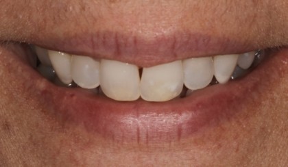 Closeup of woman's discolored dental bonding and imperfect smile