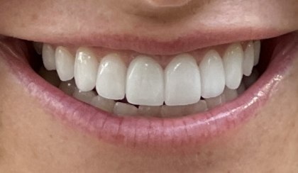 Closeup of woman's flawless smile after porcelain veneer treatment