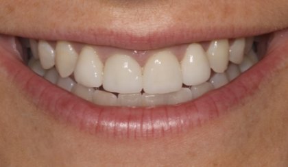 Closeup of woman's discolored dental bonding and imperfect smile