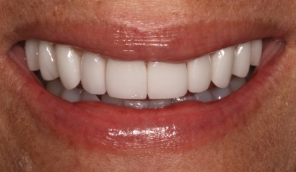 Closeup of woman's flawless smile after porcelain veneer treatment