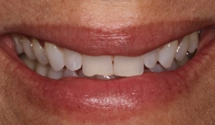 Closeup of woman's discolored dental bonding and imperfect smile