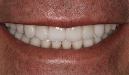 Closeup of woman's flawless smile after porcelain veneer treatment