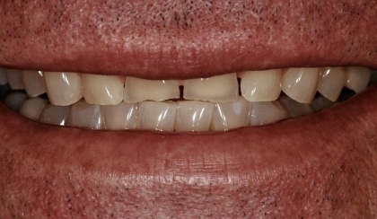 Closeup of woman's discolored dental bonding and imperfect smile