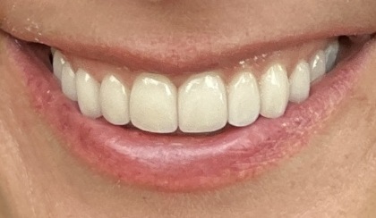 Closeup of woman's flawless smile after porcelain veneer treatment