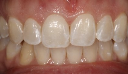 Closeup of woman's discolored dental bonding and imperfect smile