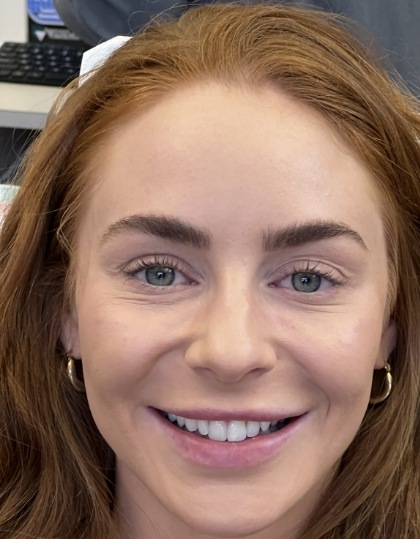 Woman with discolored dental bonding and imperfect smile