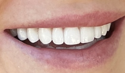 Closeup of woman's flawless smile after porcelain veneer treatment