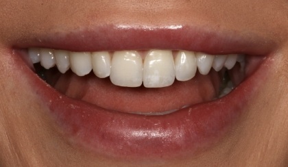 Closeup of woman's discolored dental bonding and imperfect smile