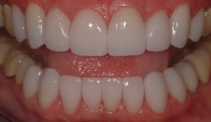 Closeup of young woman's flawless smile after porcelain veneers