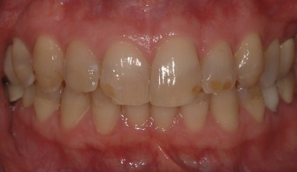 Closeup of young woman's imperfect smile before porcelain veneers