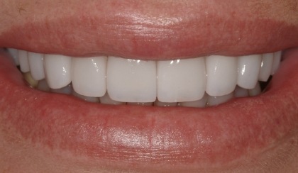 Closeup of young woman's flawless smile after porcelain veneers