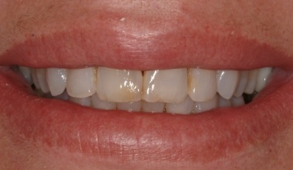 Closeup of young woman's imperfect smile before porcelain veneers