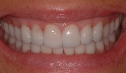 Closeup of young woman's flawless smile after porcelain veneers