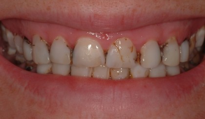 Closeup of young woman's imperfect smile before porcelain veneers