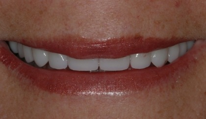 Closeup of young woman's flawless smile after porcelain veneers