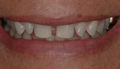 Closeup of young woman's imperfect smile before porcelain veneers