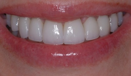 Closeup of young woman's flawless smile after porcelain veneers