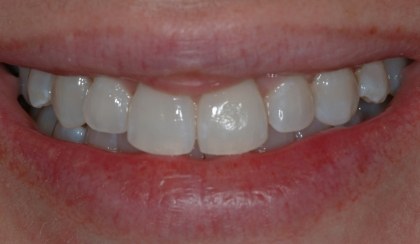 Closeup of young woman's imperfect smile before porcelain veneers