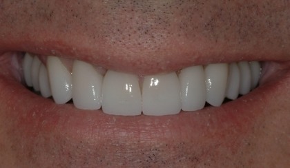 Closeup of young woman's flawless smile after porcelain veneers