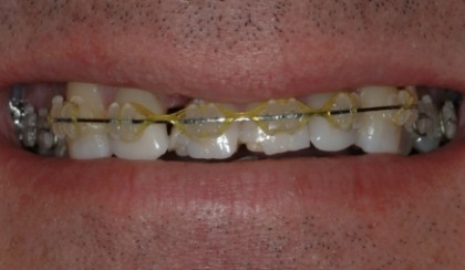 Closeup of young woman's imperfect smile before porcelain veneers