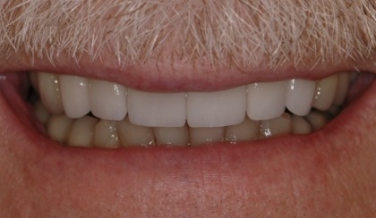 Closeup of young woman's flawless smile after porcelain veneers