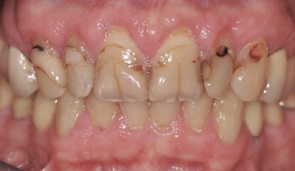 Closeup of young woman's imperfect smile before porcelain veneers