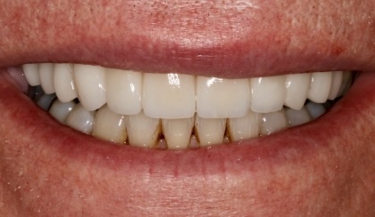 Closeup of young woman's flawless smile after porcelain veneers