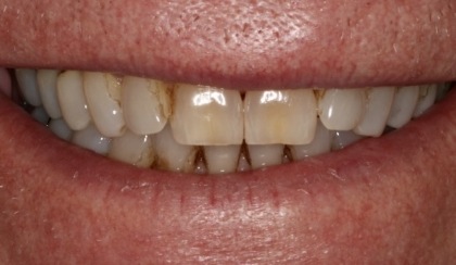 Closeup of young woman's imperfect smile before porcelain veneers